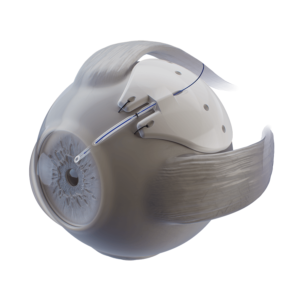 Ahmed ClearPath in Eye