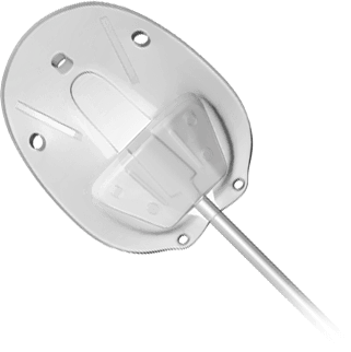 Ahmed Glaucoma Valve